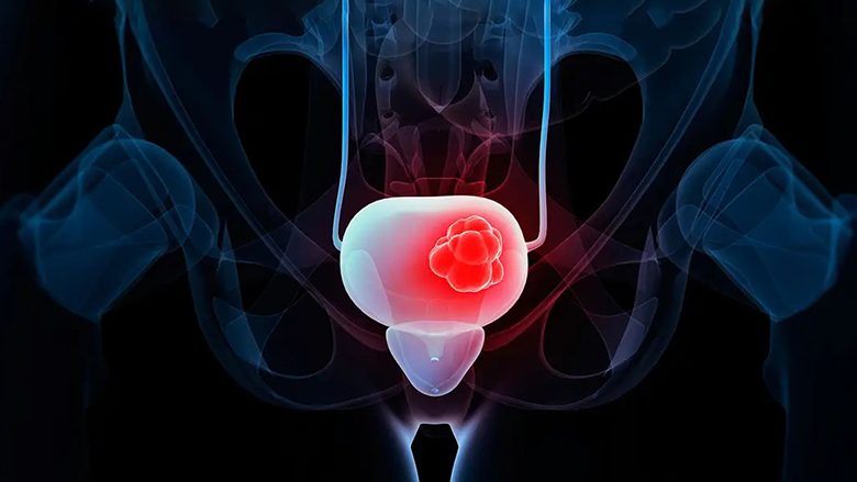 Është miratuar një trajtim i ri për një lloj kanceri të fshikëzës