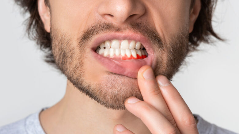 Fibrat zvogëlojnë rrezikun nga zhvillimi i sëmundja e mishit të dhëmbëve