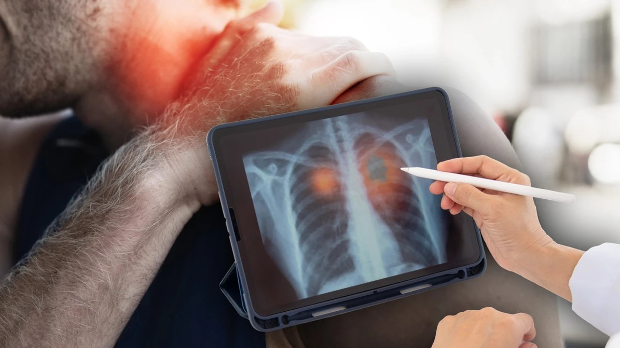 Çfarë dhimbje në shpatull mund të tregojë për kancerin e mushkërive – ndonjëherë është shenja e parë e këtij karcinomi