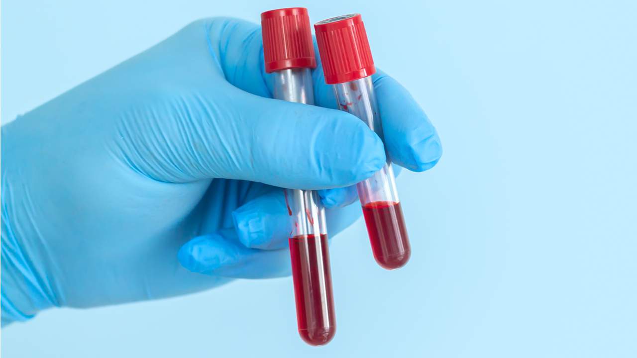 Testi i biopsisë së lëngshme nga një mostër gjaku mund të zbulojë më herët disa lloje kanceresh