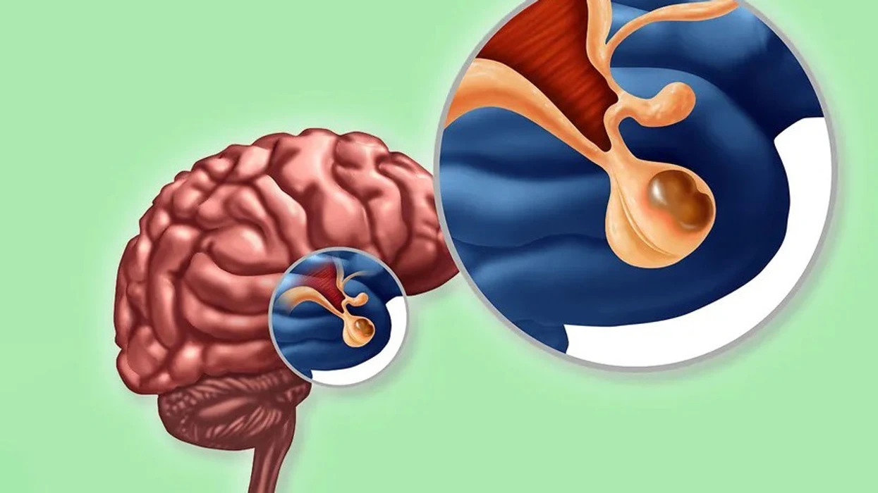 Mungesa e menstruacioneve dhe rritja e gjinjve te meshkujt: Alarm hormonal që mund të zbulojë një tumor të rrallë