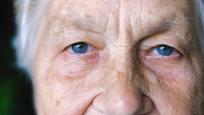 Një shenjë e fshehur në sy mund të paralajmërojë Alzheimerin shumë vite përpara?!