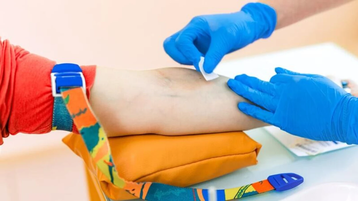 Kur palca e kockave prodhon shumë trombocite: Trombocitemia esenciale dhe mpiksjet e gjakut