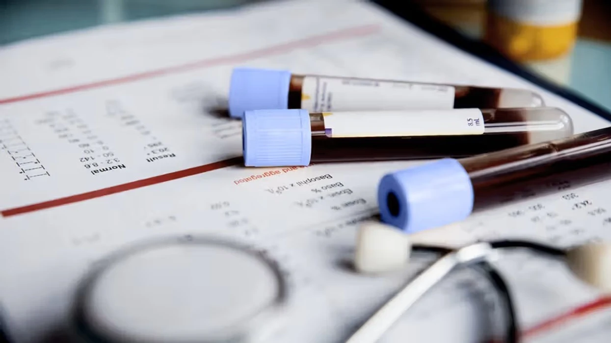 A keni mungesë apo tepricë hekuri? Ky test e tregon saktë