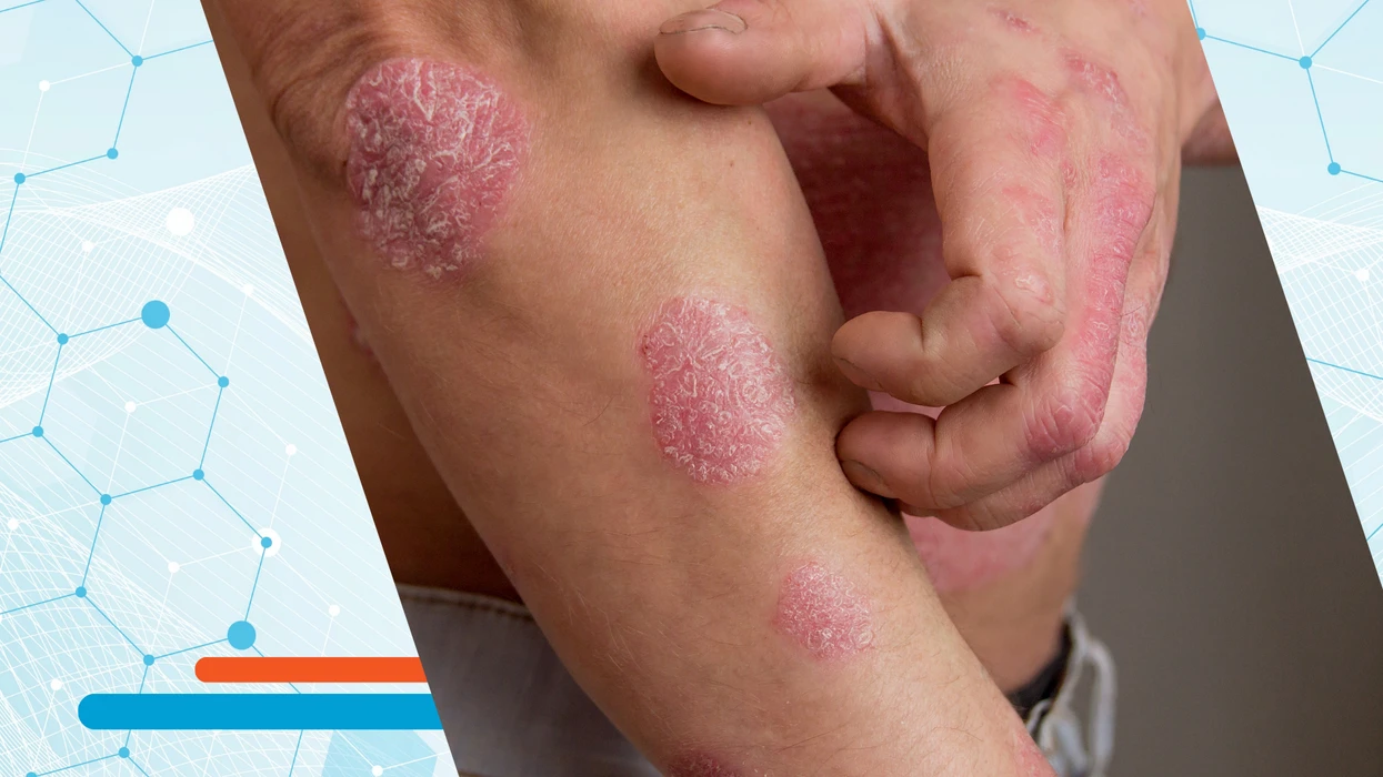 Ilaçi i parë oral për psoriazën sjell shpresë të re