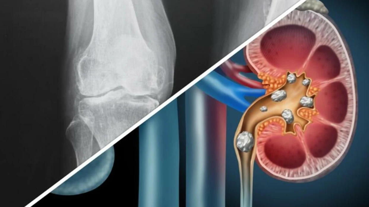 Pse krijohen kalcifikimet dhe në cilat pjesë të trupit shfaqen më shpesh